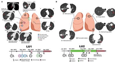 Lineage tracing for multiple lung cancer by spatiotemporal heterogeneity using a multi-omics analysis method integrating genomic, transcriptomic, and immune-related features